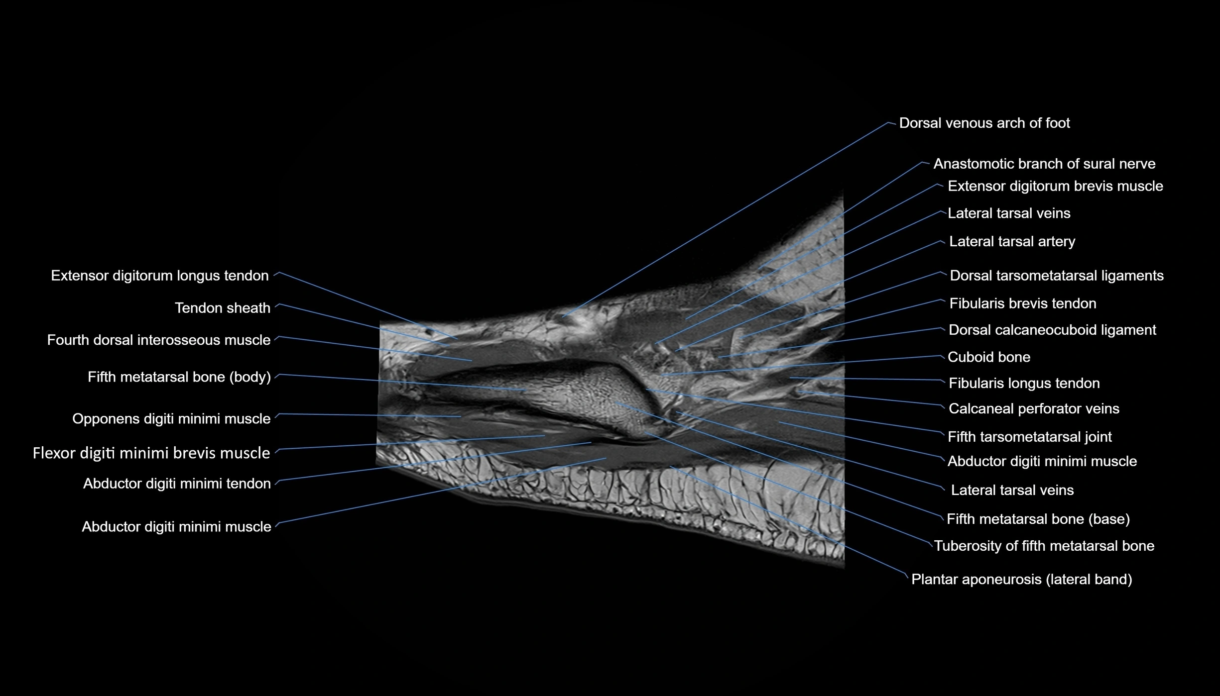 MRI mid foot sagittal cross sectional anatomy 3T  radiology  image-img-00001-00008.webp
